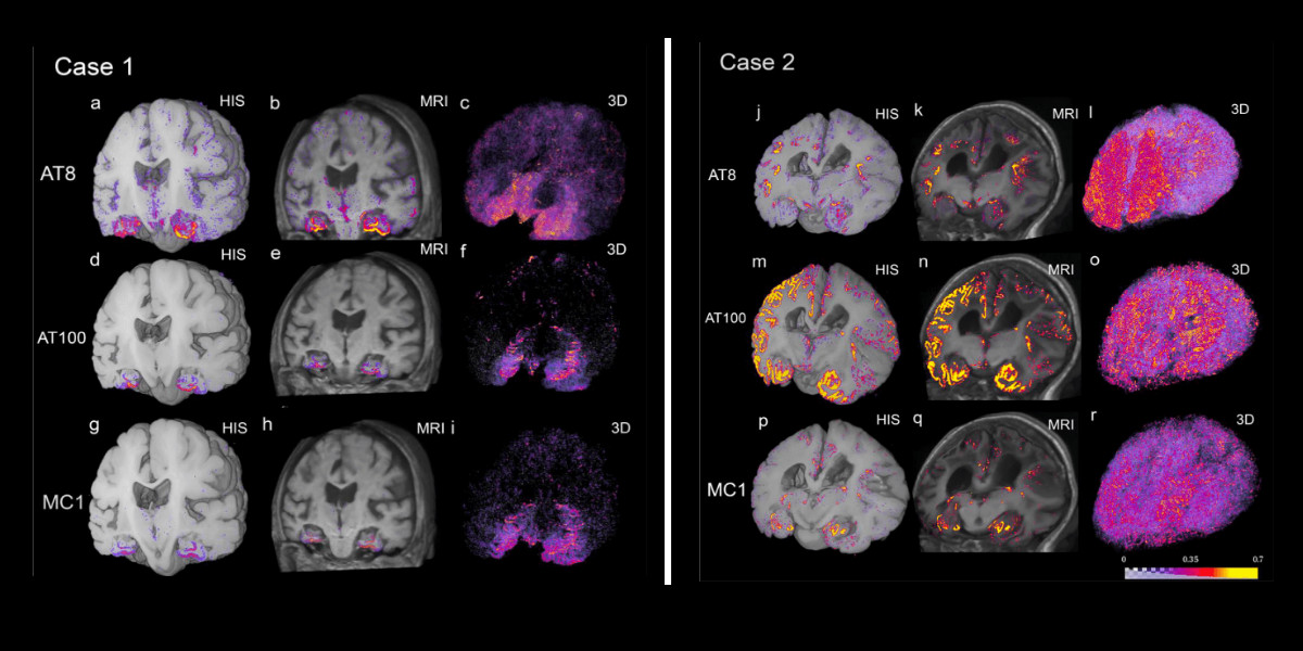 Deep Learning for Alzheimer's Disease