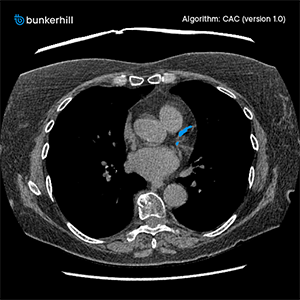 Automated AI Coronary Artery Calcium Scoring