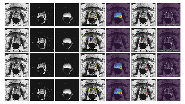 Federated Learning for Radiology