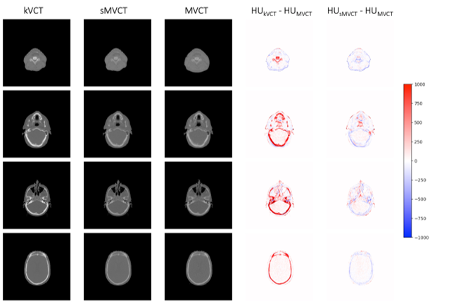 Example images from four different test subject scans of kVCT images 