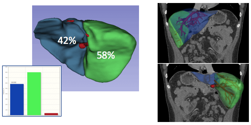 An automated data analysis model for liver transplant surgery planning.