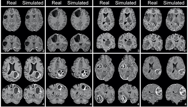 coronal brain images of patients with glioblastoma and lower-grade gliomas