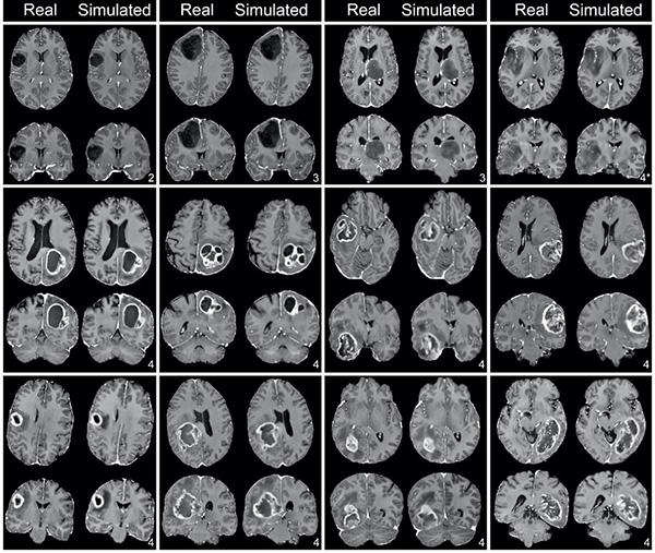 coronal brain images of patients with glioblastoma and lower-grade gliomas