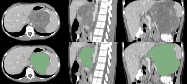 Medical research image showing how  Investigators Incorporate Radiomics into Machine Learning Models to Better Predict Neuroblastoma Outcomes