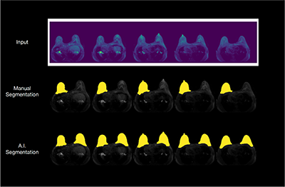 A medical image showing an example of an automated fibroglandular tissue segmentation using machine learning