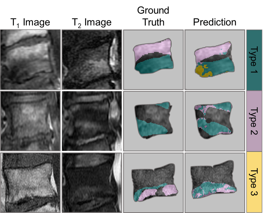 Medical image showing how AI Can Detect Changes in the Spine that May Cause Lower Back Pain