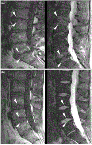 Example of endplate defects that can be routinely observed on lumbar MRI. Degenerative appearance (erosive osteochondrosis) on T1- and T2-weighted sequences (a; arrowheads) and focal Schmorl's nodes on T1- and T2-weighted sequences (b; arrowheads).