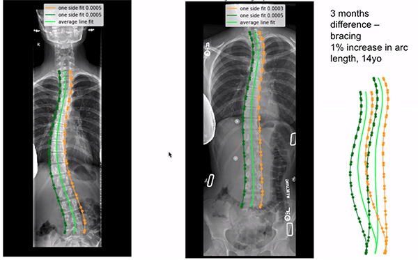 A radiograph shows improvement in spinal curvature in a 14 yo patient before and after 3 months of bracing.