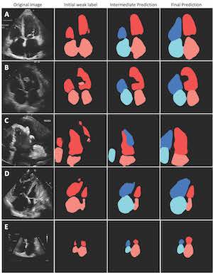 Dice scores ("Overlap, left ventricle") between the AI pipeline's LV segmentation ("AI pipeline prediction," red) and the manual LV segmentation ("EchoNet manual label") are shown.