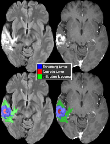 Example of 3D tumor boundaries generated by the FeTS model overlaid on MRI images from a patient with glioblastoma.