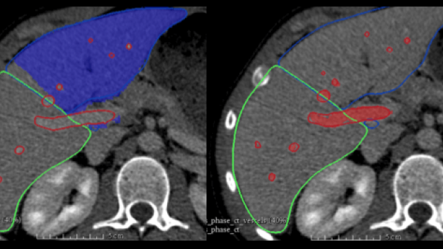 Liver Segmentation