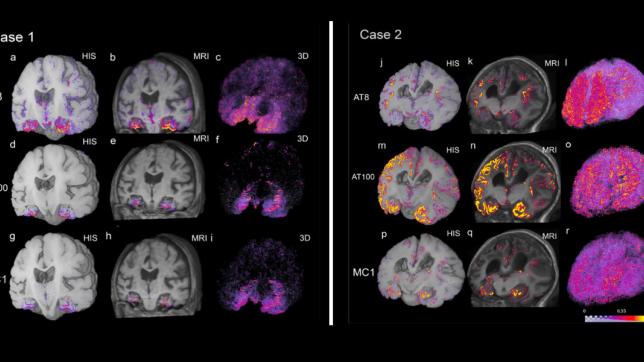 Deep Learning for Alzheimer's Disease