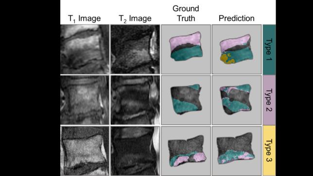 Medical image showing how AI Can Detect Changes in the Spine that May Cause Lower Back Pain