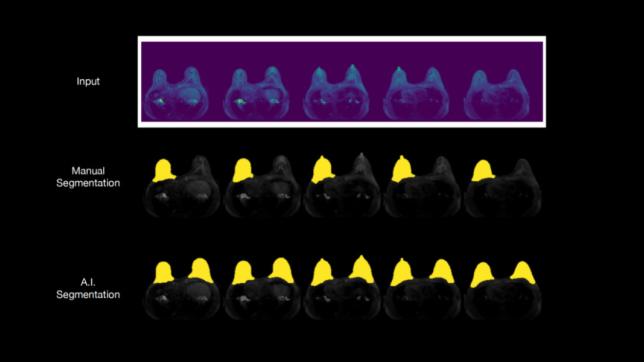 A medical image showing an example of an automated fibroglandular tissue segmentation using machine learning