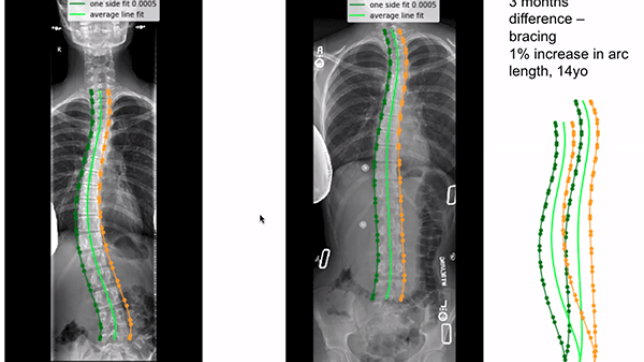A radiograph shows improvement in spinal curvature in a 14 yo patient before and after 3 months of bracing.