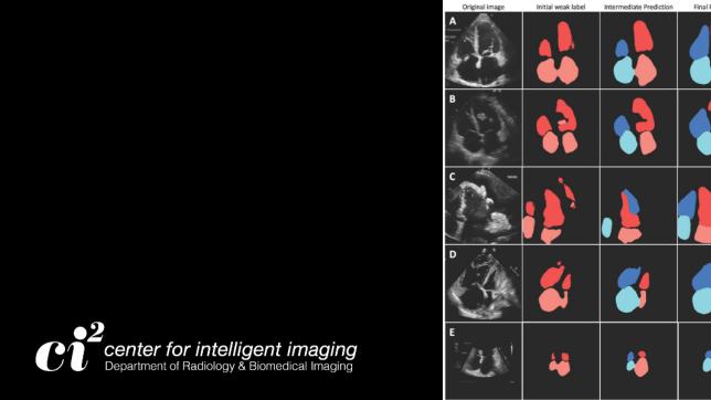 Dice scores ("Overlap, left ventricle") between the AI pipeline's LV segmentation ("AI pipeline prediction," red) and the manual LV segmentation ("EchoNet manual label") are shown.