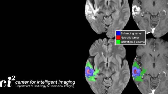 Example of 3D tumor boundaries generated by the FeTS model overlaid on MRI images from a patient with glioblastoma.