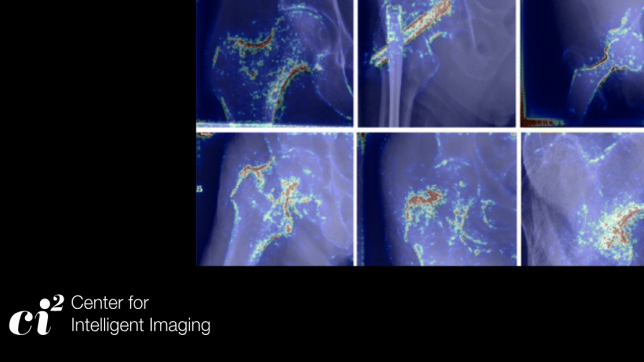 Hip Fracture Research