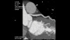 CPR of left coronary artery and aortic root