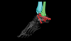 Ankle - foot in transparent to see hardware in heel and distal tibia and fibula colored