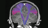 2D of brain in CT coronal view and motor and sensory tracks in color