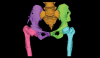 3D of pelvis and both femurs in different colors for each separate bone