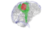 3D of brain in transparent view and sensory tracks in green and tumor in red