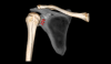 3D shoulder  - humerus and clavicle in basic bone color and scapula in transparent view with small hardware in red