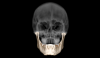 3D of skull in transparent view and mandible in basic normal bone color