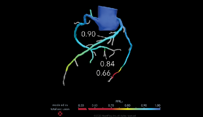 Coronary Fractional Flow Reserve showing aorta and major coronary arteries stenosis