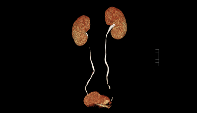 3D of kidneys, bladder and uretra