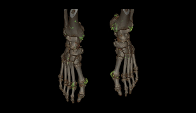 CT Gout case - Uric acid composition on foot