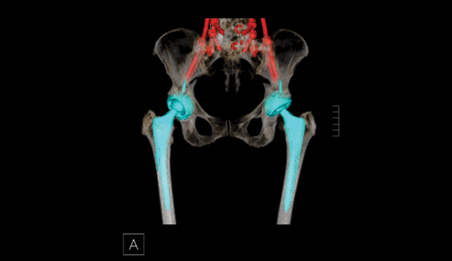 3D of pelvis and both femurs in transparent view, and hardware in red and blue color