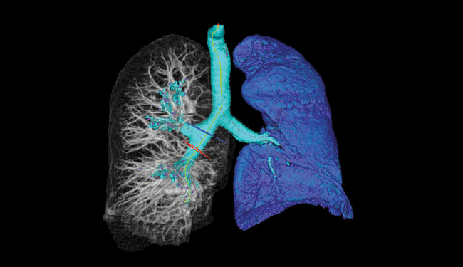 Trachea and 2 left and right lungs. Left lung represented in blue, right is transparent