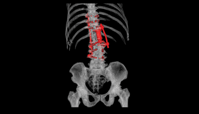 Pelvis and spine in transparent view and hardware in red