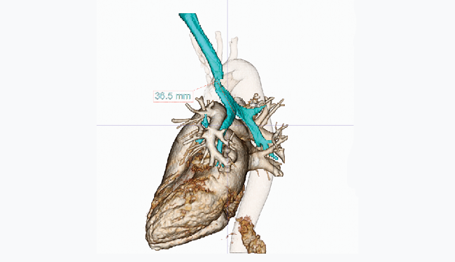 Congenithal heart disease case where trachea is narrowed and the stenosis measurement in 3D