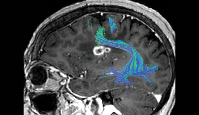 2D sagittal view of head with tumor in brain and motor tracks represented in blue