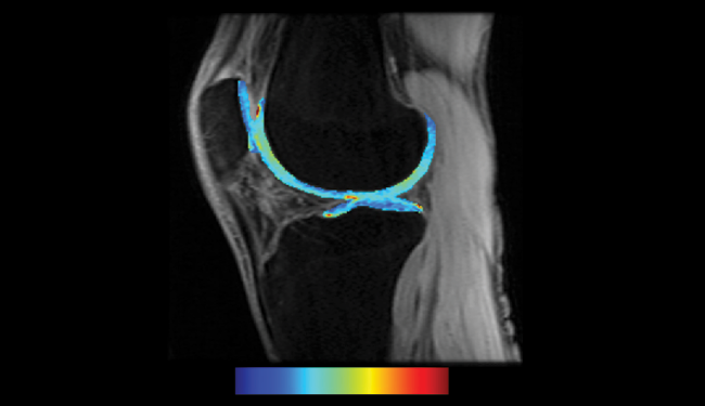2D of cartilage damage