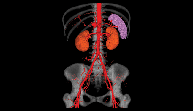 3D of aorta with hepatic artery aneurysm, kidneys and transparent bone in the background