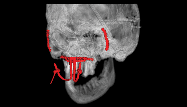 Skull in transparent view with hardware in red - postsurgical case